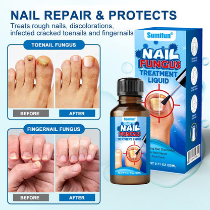 Antifungal Nail Fungi Treatment | 30ml