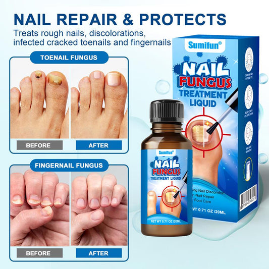 Antifungal Nail Fungi Treatment | 30ml